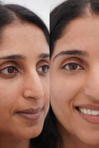 eyebrow-hairtransplant